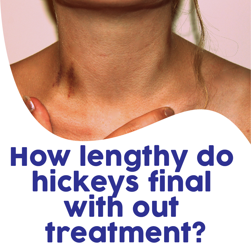 How To Get Rid Of A Hickey In An Hour